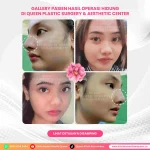Soal Alasan Operasi Plastik, Elly Sugigi: Hidung Aku Agak Miring, Apa yang Mendorongnya?