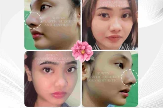 Soal Alasan Operasi Plastik, Elly Sugigi: Hidung Aku Agak Miring, Apa yang Mendorongnya?