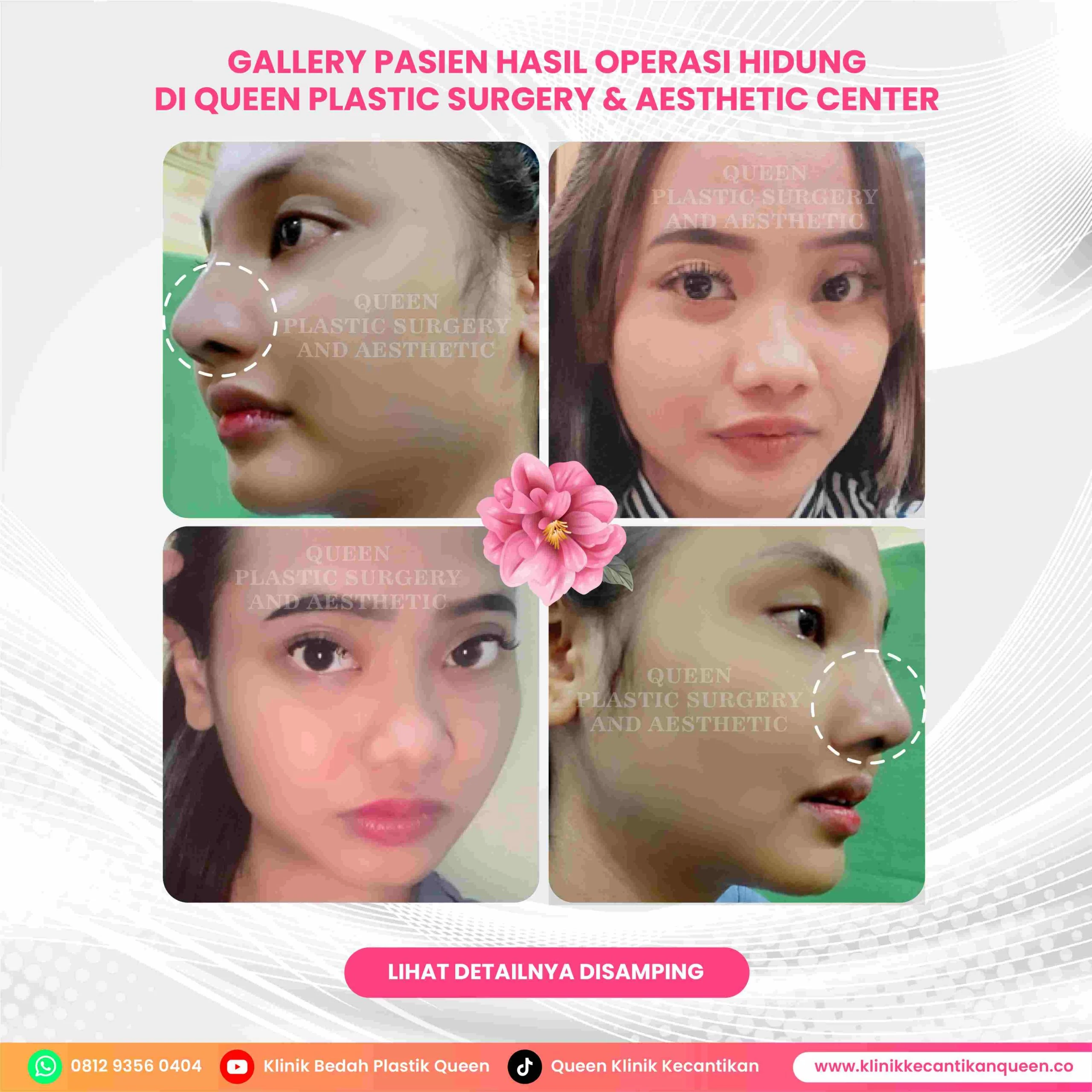 Soal Alasan Operasi Plastik, Elly Sugigi: Hidung Aku Agak Miring, Apa yang Mendorongnya?